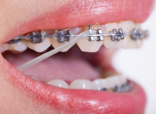 Closeup of smile with traditional braces