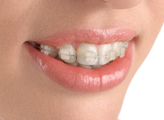 Closeup of smile with ceramic braces