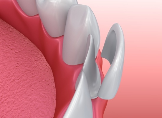 Animated smile during porcelain veneer placement