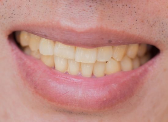 Closeup of discolored smile before teeth whitening