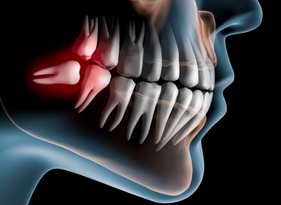 Animated smile with impacted wisdom tooth