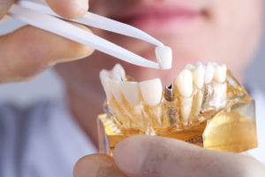 Can a dentist near me in Lenexa place dental implants?”