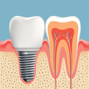 Complete your smile with dental implants in Greater Heights.