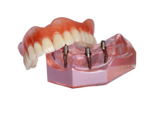 Model All-on-4 denture