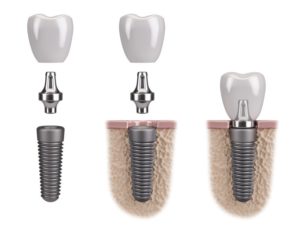 dental implants illustration