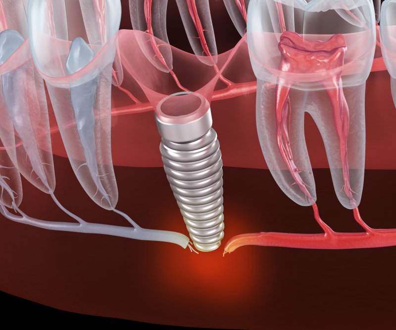 3D illustration of dental implant failure