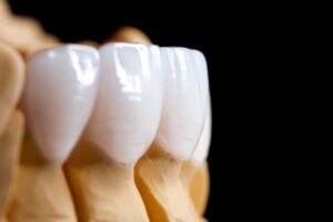 Close-up of placed on tooth mold.